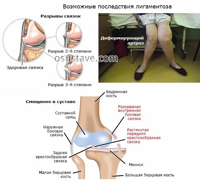 Разрыв связок коленного сустава симптомы фото Обзор лигаментоза коленного сустава: механизм развития, признаки, лечение Совет 