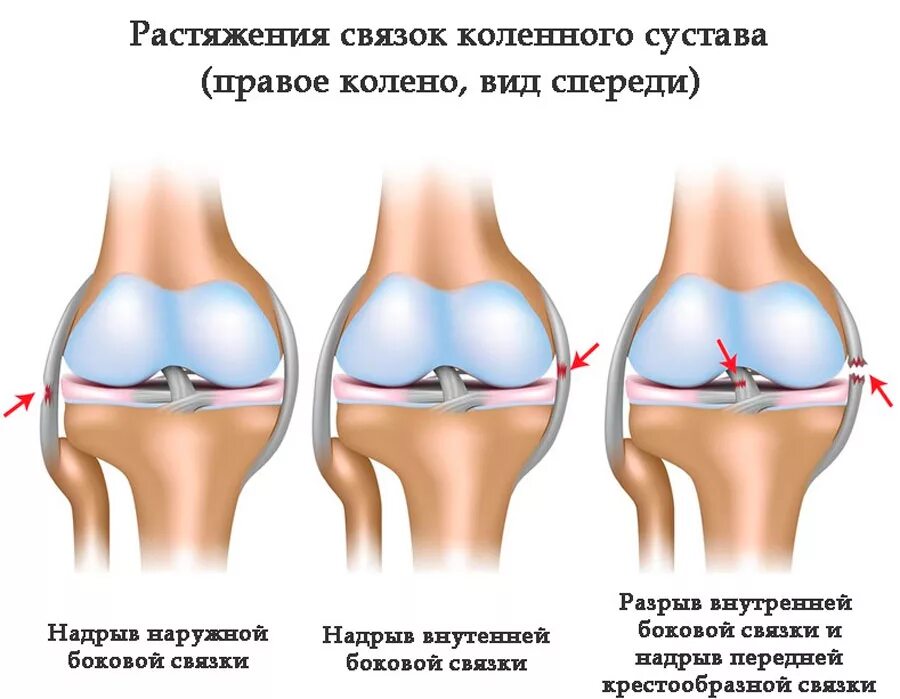 Разрыв связок коленного сустава симптомы фото Травмы связок колена: как восстановить колено, виды повреждений