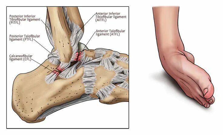 Разрыв связок стопы симптомы и лечение фото Ankle training Part 1 Sprained ankle, Sprain, Ankle ligaments