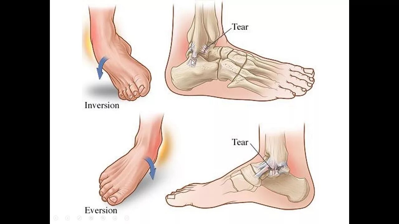 Разрыв связок стопы симптомы и лечение фото ต ำ ร า ค ว า ม เ จ บ ป ว ด เ ร อ ง ข อ เ ค ล ด ข อ แ พ