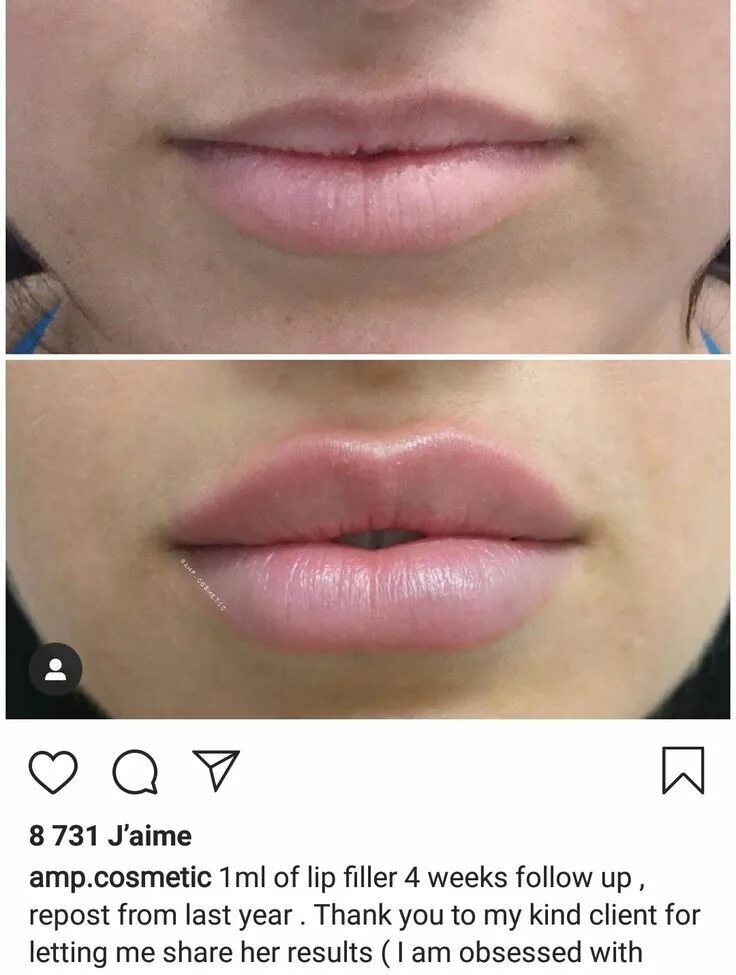 Разворот верхней губы ботоксом фото Lip Filler Before & After Lip fillers, Botox lips, Lips inspiration