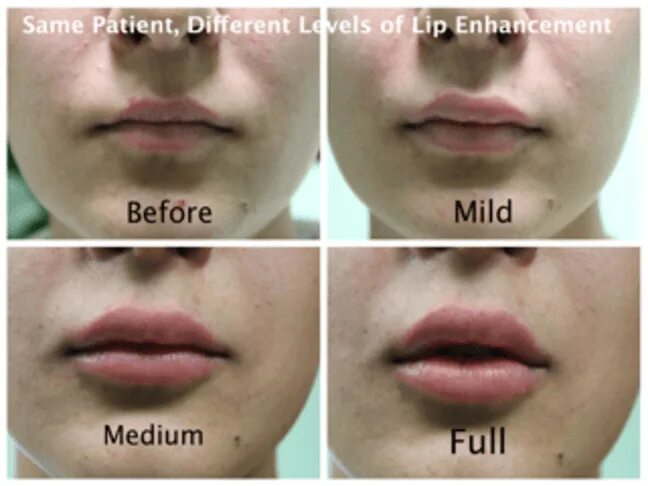 Разворот верхней губы ботоксом фото Lip help