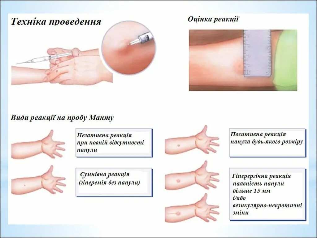 Реакция бцж по месяцам фото Діагностика туберкульозу. (Лекція 2) - презентация онлайн