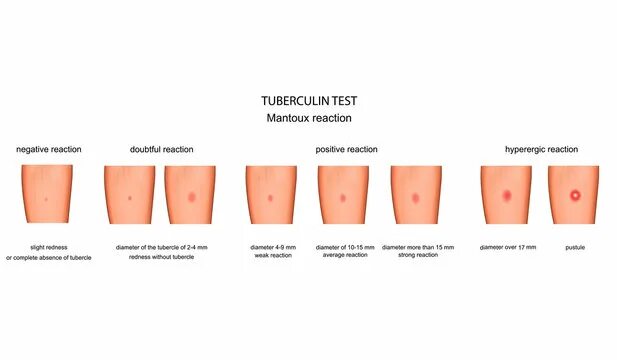 Реакция манту какая должна быть фото Tuberculosis Test Зображення - огляд 8,935 Стокові фото, векторні зображення й в