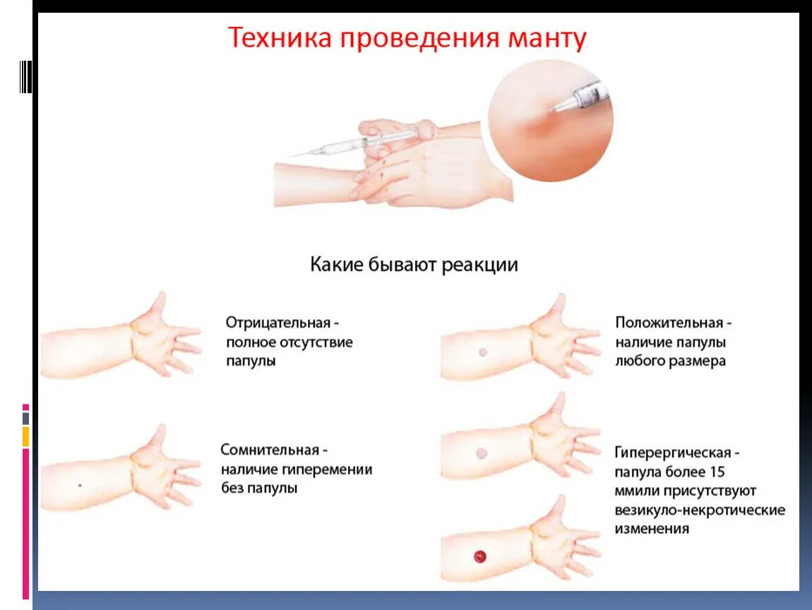 Реакция манту какая должна быть фото Проба реакции диаскинтест