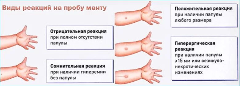 Реакция манту какая должна быть фото Проба манту детям в год