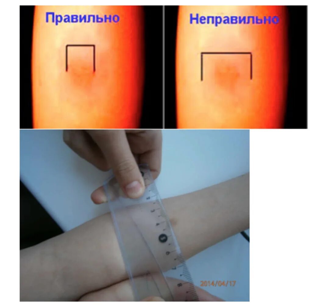 Реакция манту какая должна быть фото Через сколько после манту можно делать: найдено 89 изображений