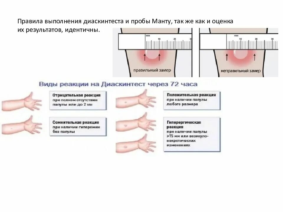 Реакция манту какая должна быть фото Поставить реакцию манту - найдено 90 картинок