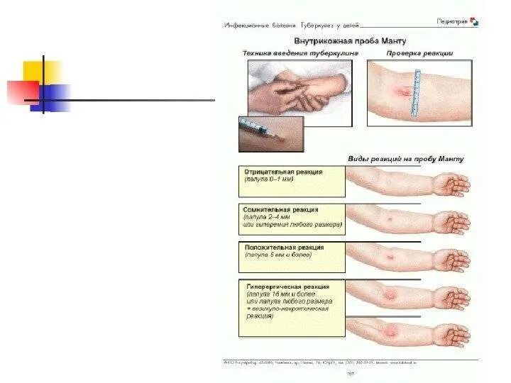 Реакция манту какая должна быть фото Картинки ДИАГНОСТИКА ТУБЕРКУЛЕЗА МАНТУ