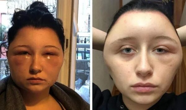 Реакция на фото бывшей I almost died': Young French woman disfigured by an allergic reaction to hair dy