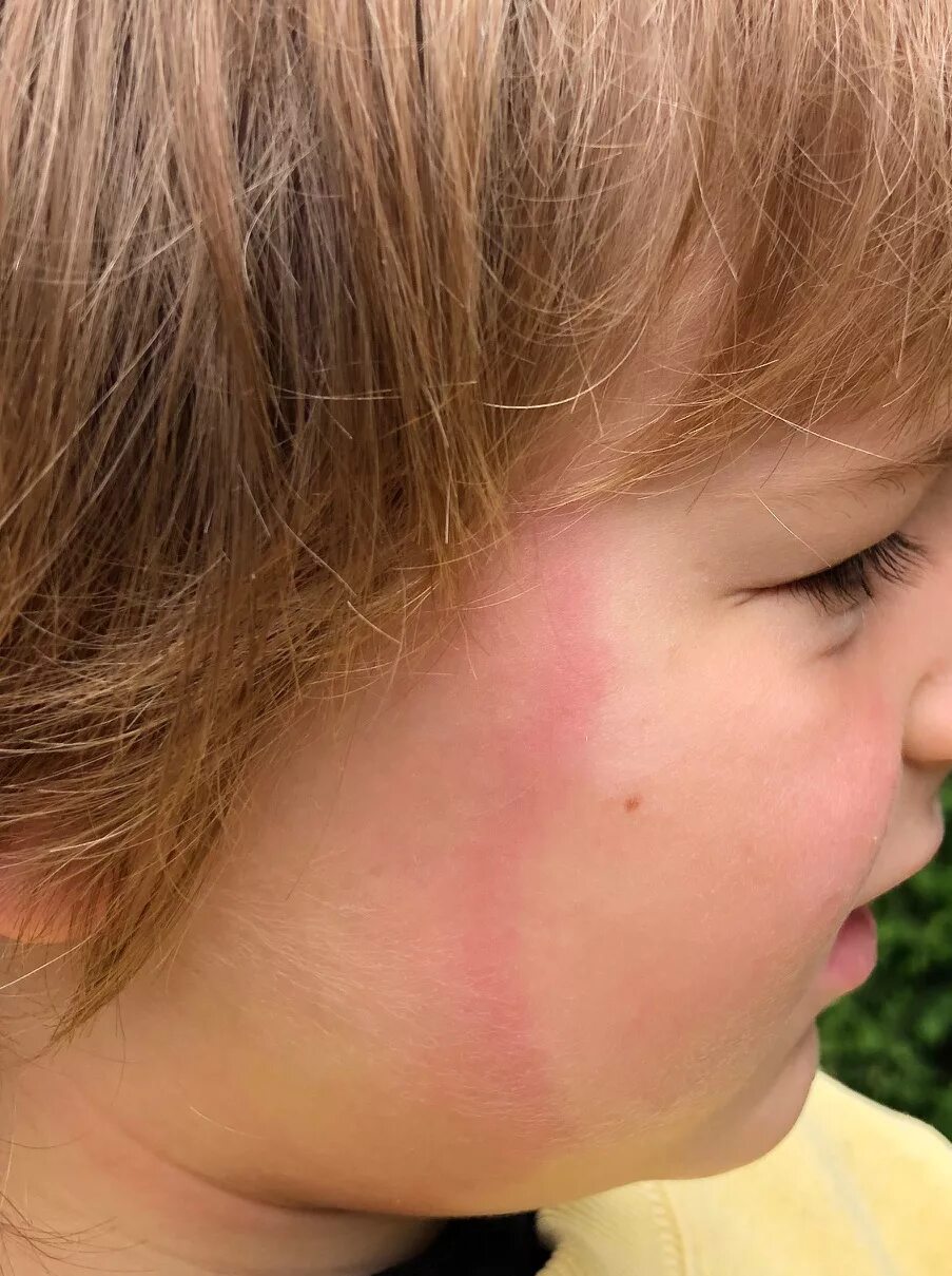 Реакция на укус клеща фото File:Lyme Disease Rash.jpg - Wikipedia