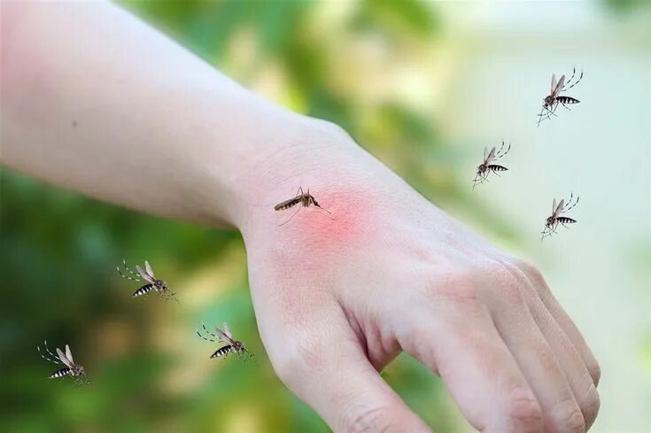 Реакция на укусы комаров фото Descubren por qué algunos mosquitos prefieren a los humanos Como eliminar mosqui