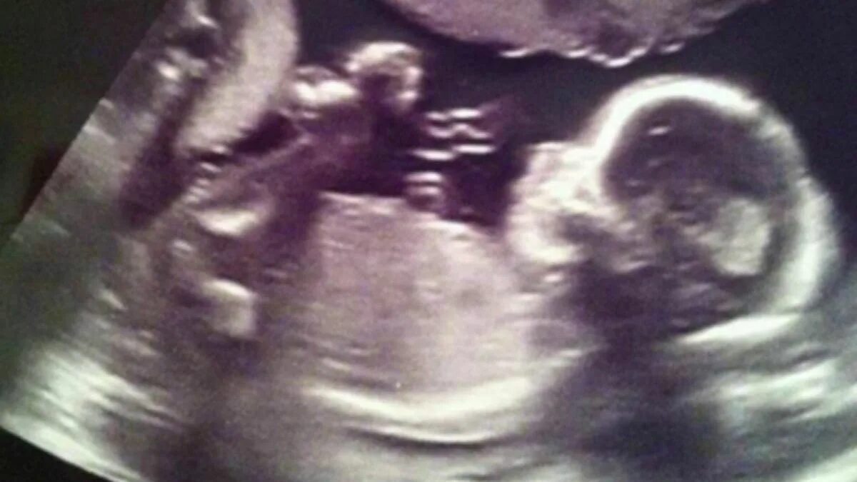 Ребенок 16 недель фото Heartwarming picture shows 'angel' watching over unborn baby in ultrasound scan 