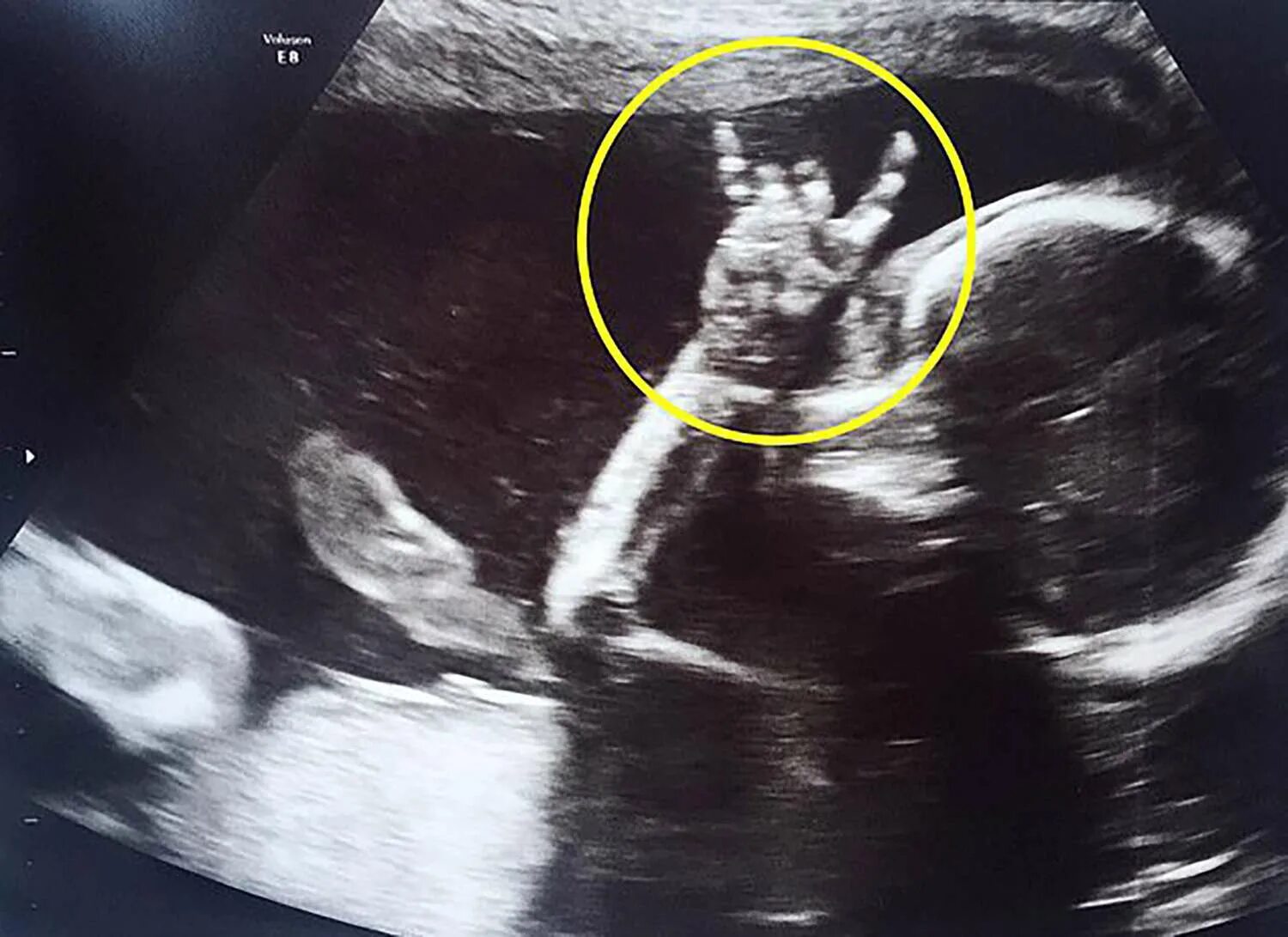 Ребенок 20 недель фото узи Rockstar Baby Gives the 'Sign of the Horns' in the Womb