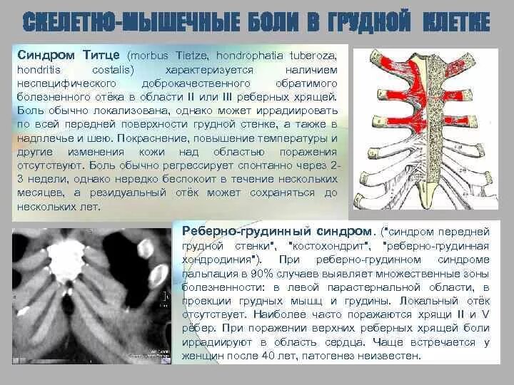 Реберный хондрит симптомы и лечение фото Грудные Суставы Болят - Buy-artox.ru