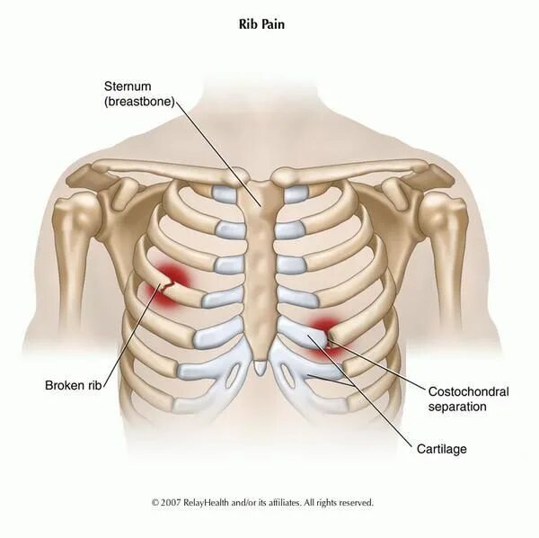 Реберный хондрит симптомы и лечение фото causes of upper back pain when breathing deeply Medicina, Fisio