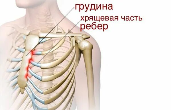 Реберный хондрит симптомы и лечение фото Мастодиния (масталгия): причины, симптомы и лечение в статье гинеколога Кучер Е.