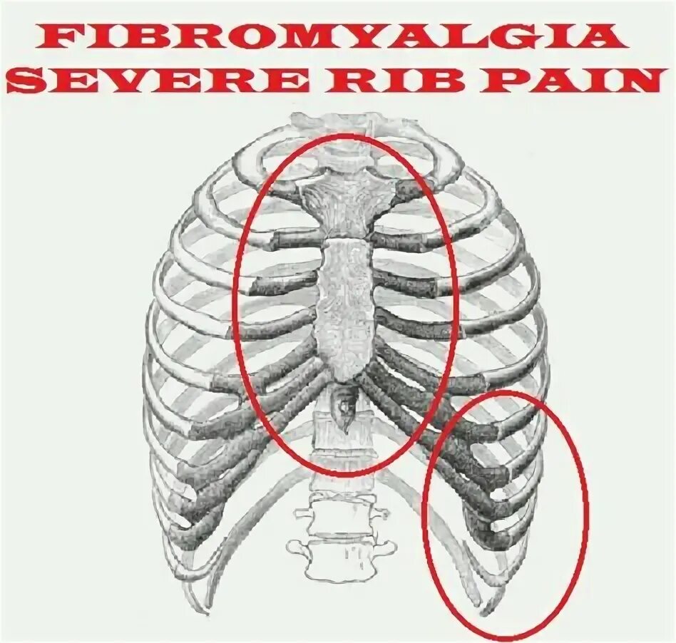 Реберный хондрит симптомы и лечение фото 63 Interesting Facts ideas fibromyalgia, chronic fatigue, fibromyalgia awareness