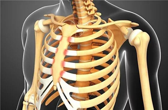 Реберный хондрит симптомы и лечение фото Синдром Титце: симптомы и лечение, причины болезни реберный хондрит Клиника Teme