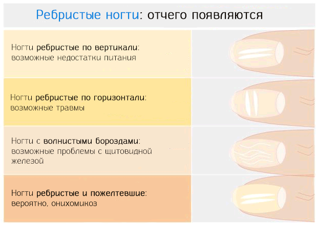 Ребристые ногти на руках причины фото Ребристые ногти: причины появления борозд на ногтях пальцев - Уголок красоты "Ам