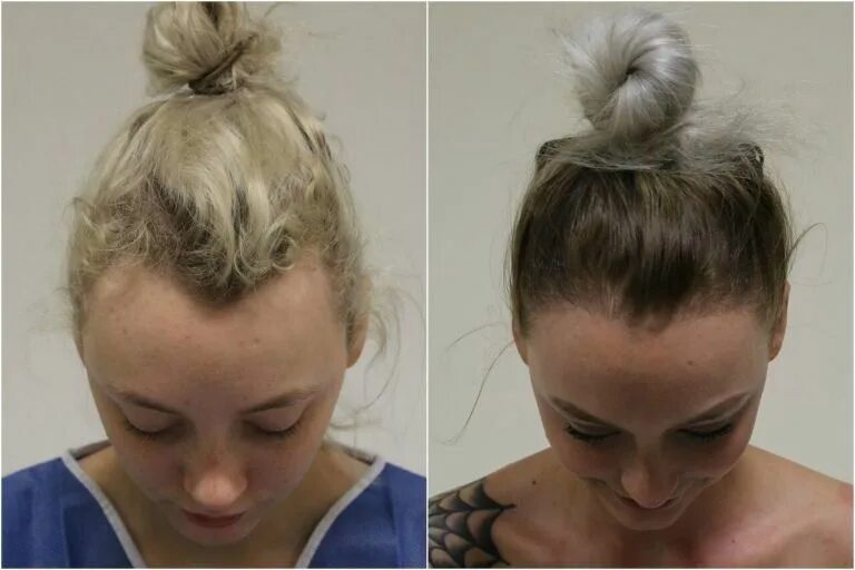 Редкие волосы какую прическу сделать Pin on Alopecia