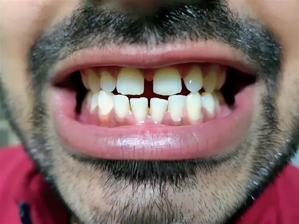 Редкие зубы фото Gap Tooth Изображения: просматривайте стоковые фотографии, векторные изображения