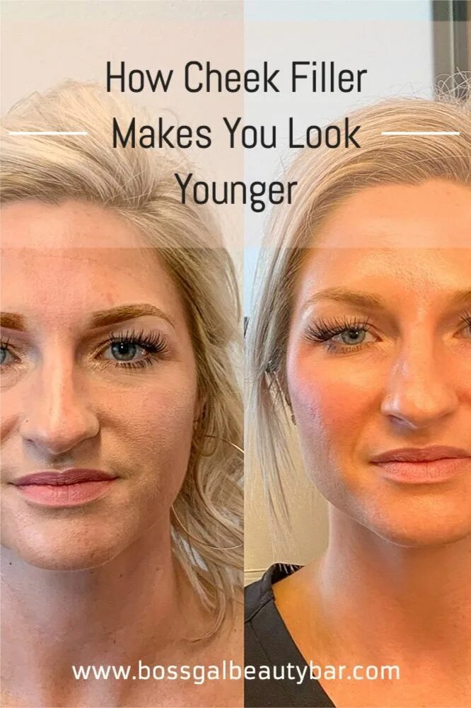 Реконструкция фото до и после How Cheek Filler Makes You Look Younger Cheek fillers, Botox fillers, Voluma che