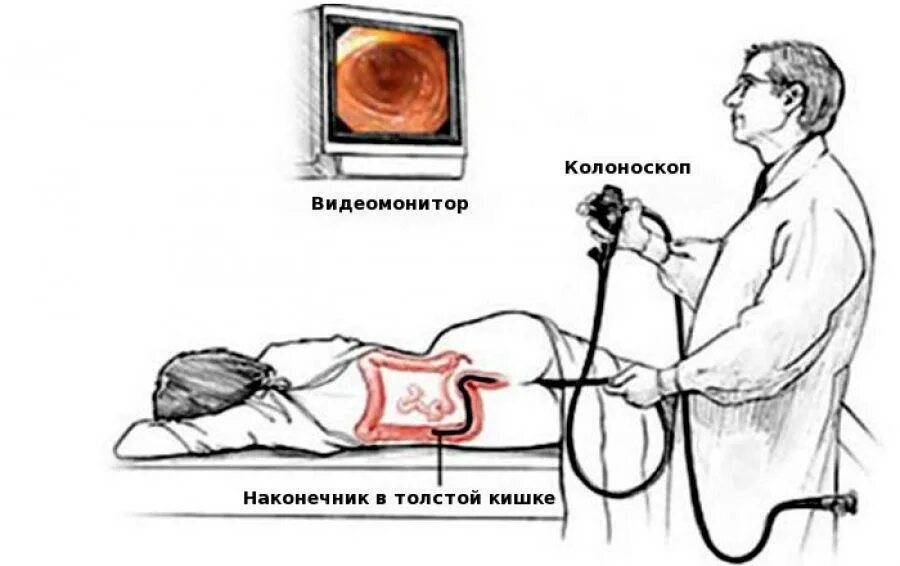 Ректороманоскопия при геморрое как выглядит Обследование кишечника колоноскопия
