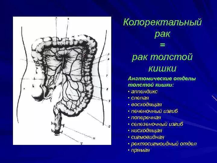 Ректосигмоидный отдел фото Опухоль ректосигмоидного отдела толстой кишки: найдено 82 картинок