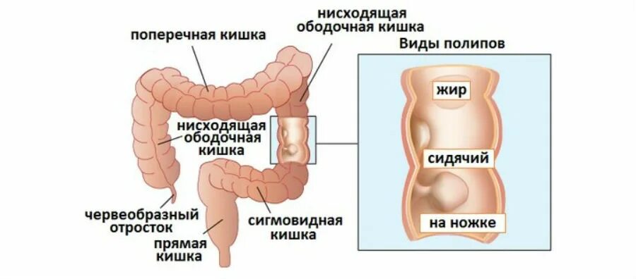 Ректосигмоидный отдел кишечника где находится фото Семейный аденоматозный полипоз толстой кишки Университетская клиника