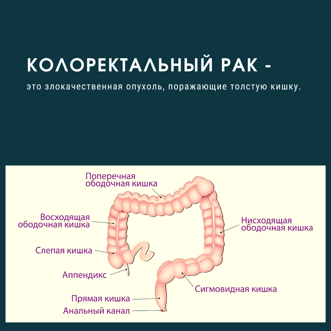 Ректосигмоидный отдел кишечника где находится фото Рак толстой кишки. Какие симптомы? Когда и как выявить на ранней стадии. Дневник