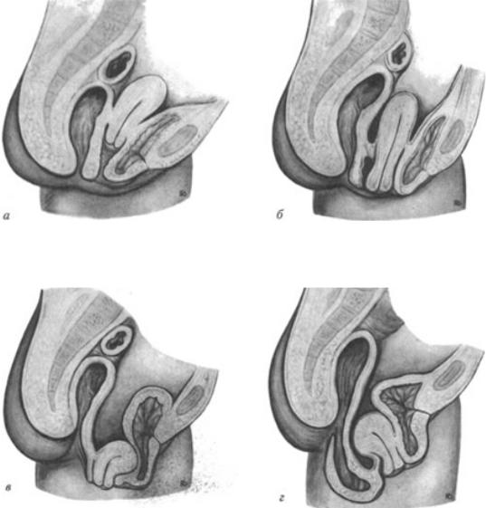 Ректоцеле что это такое фото Перинеология_Опущение_и_выпадение_половых_органов_Радзинский_В_Е - Стр 18