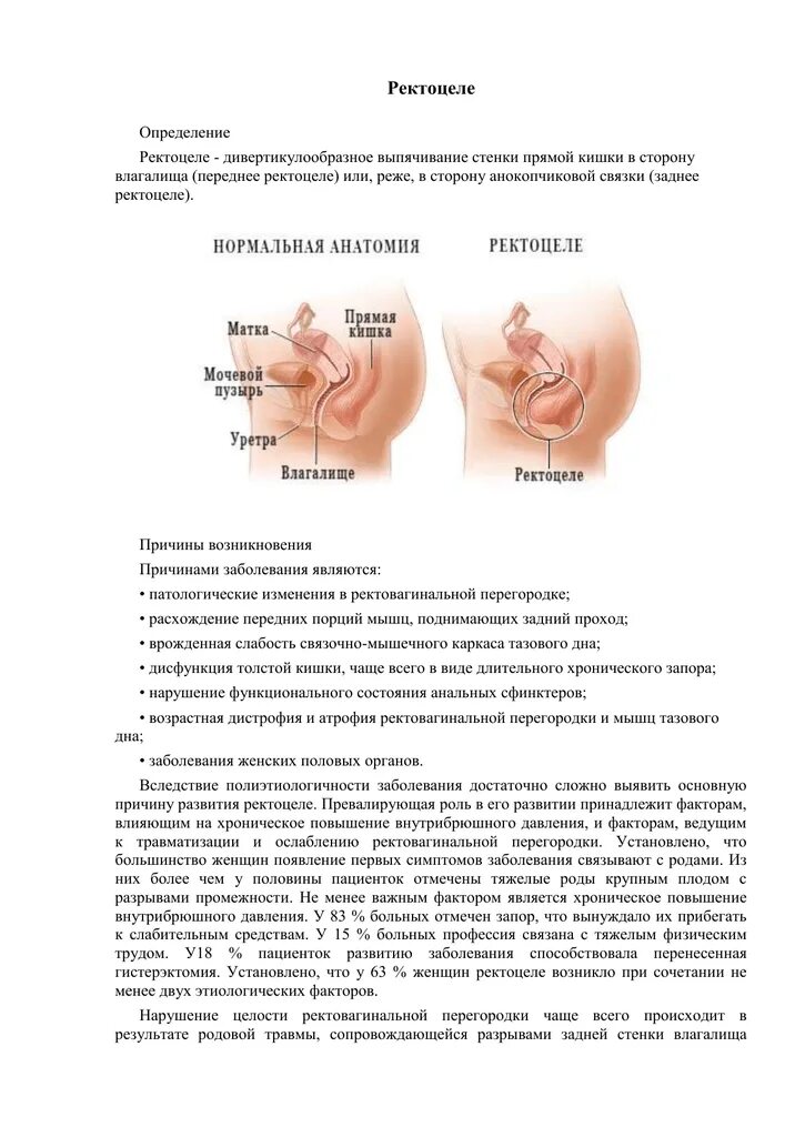 Ректоцеле что это такое фото Ректоцеле