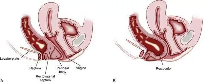 Ректоцеле что это такое фото Constipation Clinical Gate