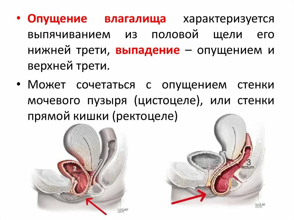 Ректоцеле что это такое у женщин фото Выпадает матка после родов