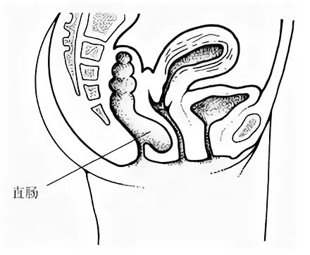 Ректоцеле что это такое у женщин фото Ректоцеле - Сторінки 3 - Всесвітній енциклопедичні знання