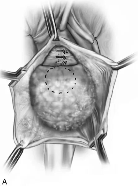 Ректоцеле что это такое у женщин фото Vaginal Repair of Cystocele, Rectocele, and Enterocele Obgyn Key