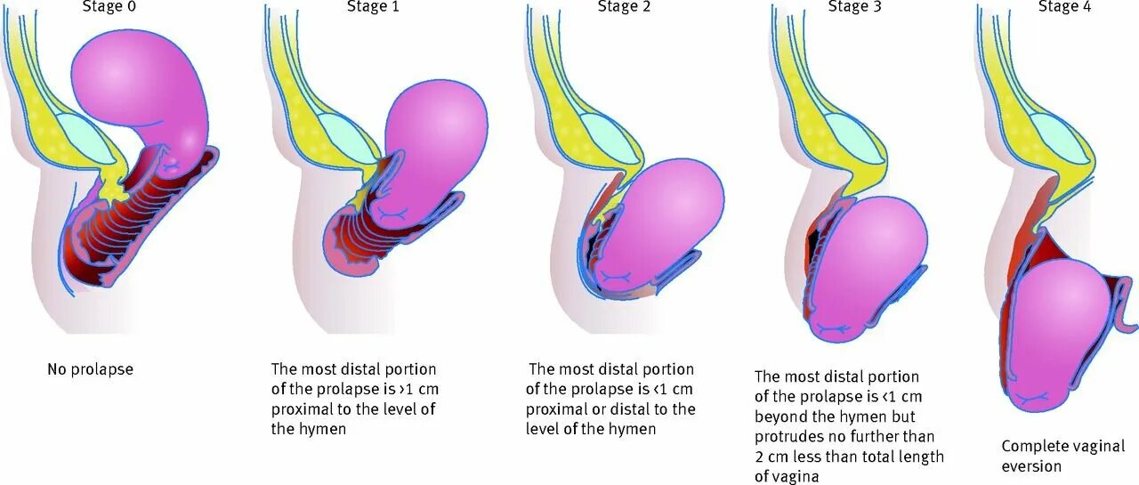 Ректоцеле что это такое у женщин фото Receive exclusive offersUterine Prolapse During Pregnancy: Stages And Its Treatm