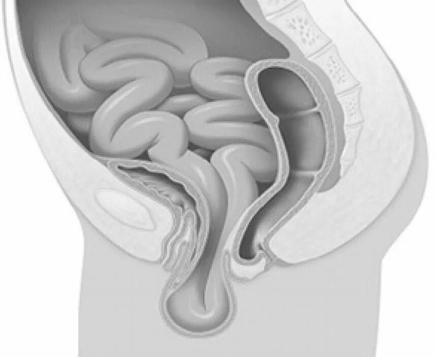 Ректоцеле что это такое у женщин фото Энтероцеле - симптомы, диагностика, лечение - Александр Никитин. Тел: +7(926)278