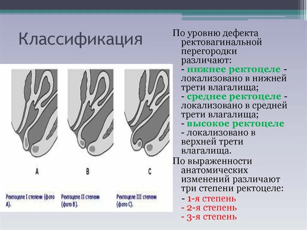 Ректоцеле что это такое у женщин фото Ректоцеле клинические рекомендации тесты с ответами