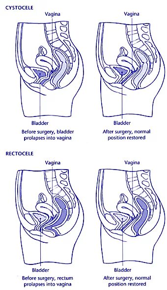 Ректоцеле что это такое у женщин фото Mr Michael Stafford Private Gynaecologist Consultant Pregnancy Control London