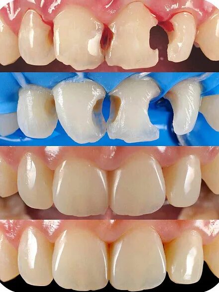 Ремонт зубов своими руками Эстетическая реставрация зубов в СПб - Крона Дент - цены