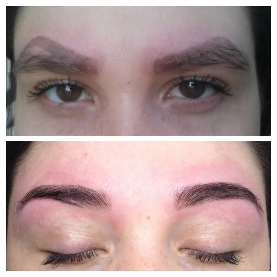 Ремувер бровей фото до и после Removal of permanent eyebrow makeup by laser .Result after 4 procedures, ahead o