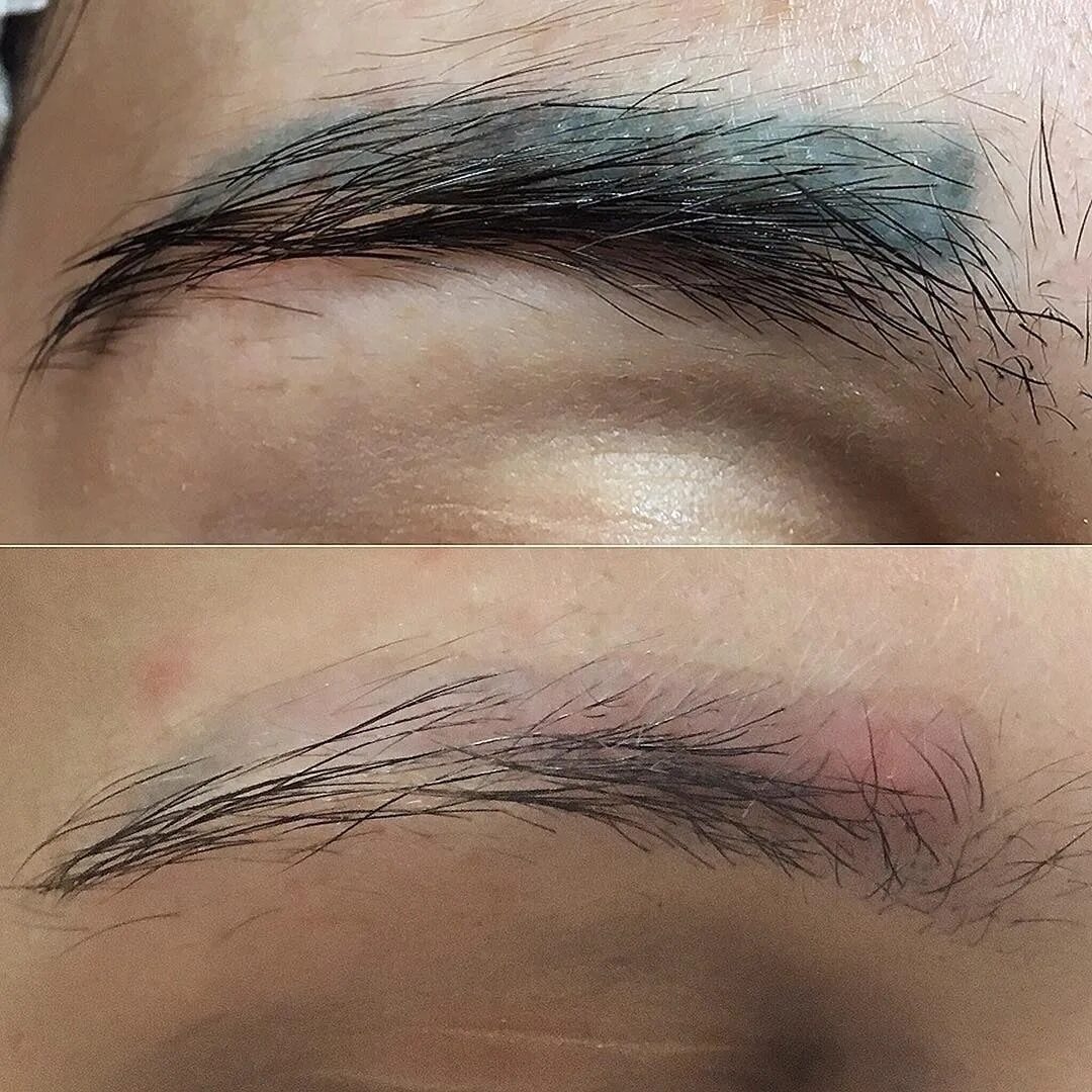 Ремувер для татуажа бровей фото после LASER or REMOVER? If we are talking about removing gray, blue, purple, gray shad