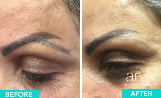 Ремувер фото до и после Hair Removal Eyebrows Permanent Clearance poligraf-ti.kz