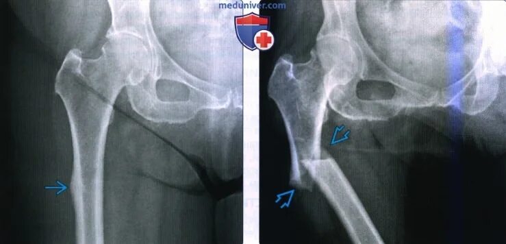 Рентген бедренной кости фото Рентгенограмма, КТ при подвертельном переломе и переломе диафиза бедренной кости