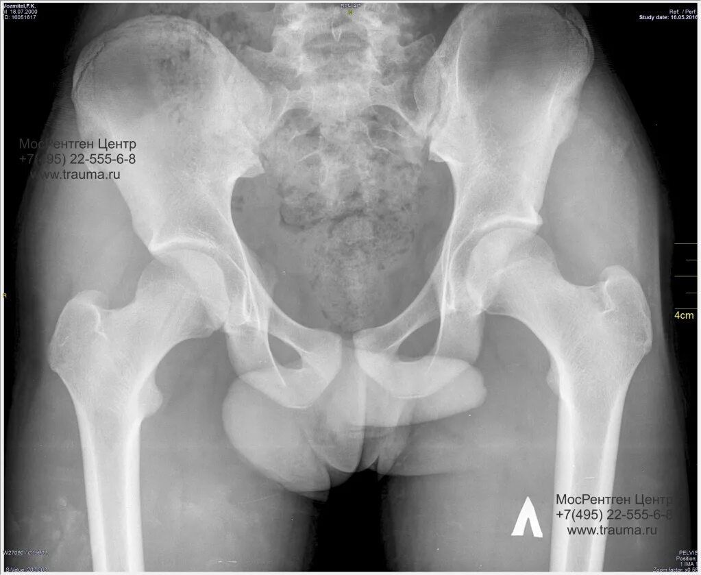 Рентген бедренной кости фото Рентген тазобедренного сустава и таза