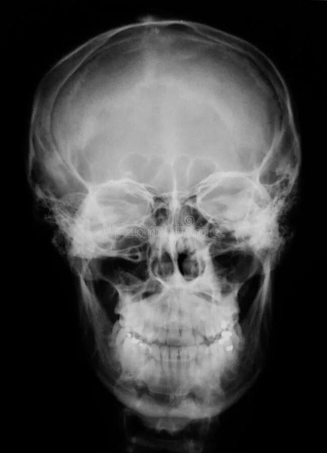 Рентген черепа фото Skull stock image. Image of medical, xray, vision, anatomy - 675909