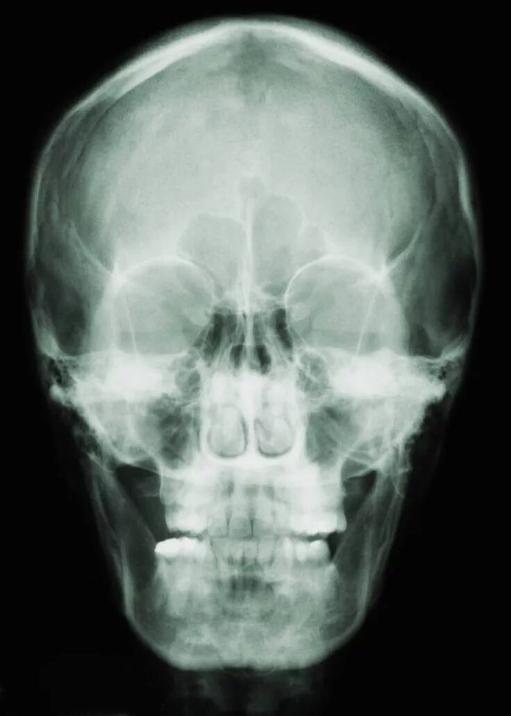 Рентген черепа фото Skeletal System Overview - Lesson X ray, Skeletal, Radiology