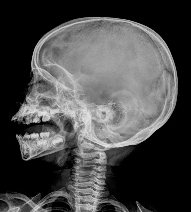 Рентген черепа фото Xray stock image. Image of asian, blank, open, cervical - 54697417